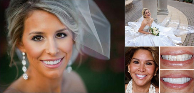 Beautiful Bridal Smile from Texas Center for Cosmetic & Implant Dentistry